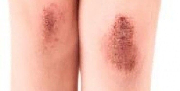 Bacaklardaki morluklara dikkat!