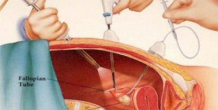 Elazığ'da ilk defa laparoskopi yöntemiyle rahim ameliyatı yapıldı
