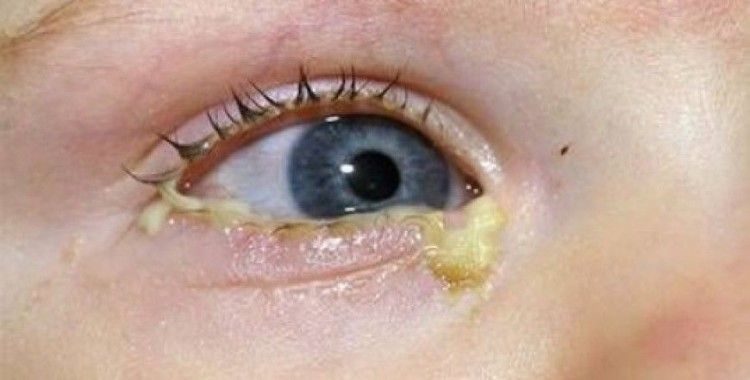  Rüyada çapak görmek ne demek ?