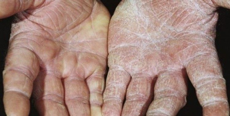 Mantar hastalıklarını nasıl önleriz ?