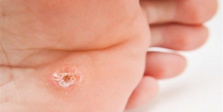 Ayak tabanı siğilleri bulaşıcı olabilir