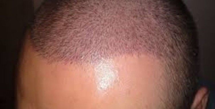 Her yerde saç ekimi yaptırmayın