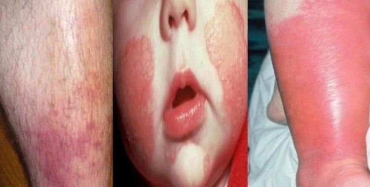 Selülit iltihabına dikkat