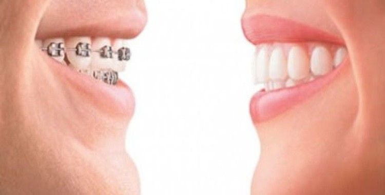 Estetik görünümlü dişler için diş teli şart mı