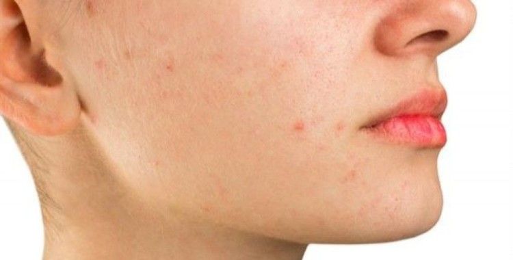 Ciltte oluşan izlere dikkat