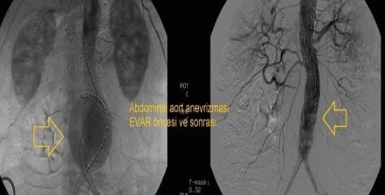 Aort damarındaki genişleme için EVAR tedavisi