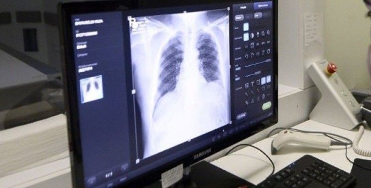 Türkiye'de ilk kez kanser hastasına akciğer nakli yapıldı