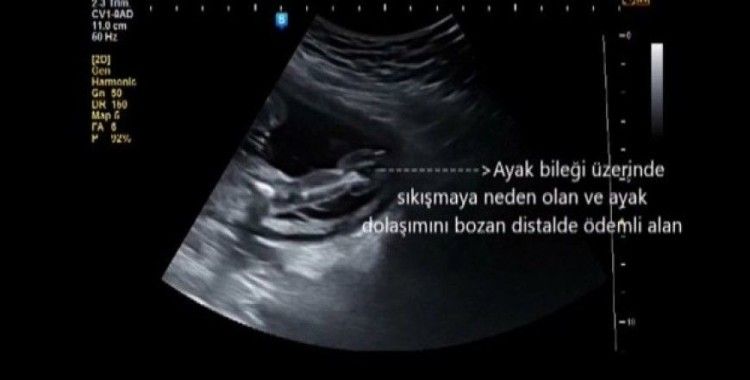 Ayağı gelişmeyen bebeğe anne karnında operasyon