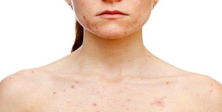 Vücutta bakteri belirtileri