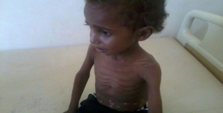 Yemenli çocukların yüzde 80'i insanı yardıma muhtaç