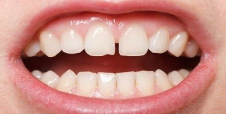 Zirkonyum ile ayrık dişlerinizden kurtulun