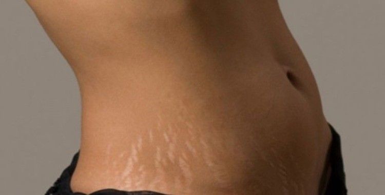 Striort metodu ile vücut çatlaklarına son