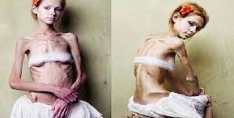 Anoreksiya nedir?