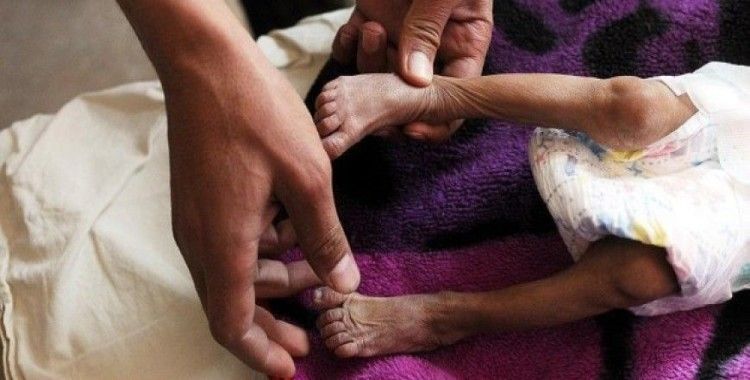 Yemen'de yaklaşık 85 bin çocuk yetersiz beslenmeden ölmüş olabilir