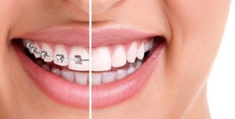 Çarpık dişlere telsiz çözüm