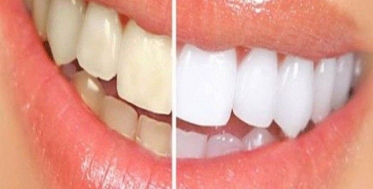 Dişlerde renk değişimine dikkat