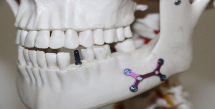 Otomobil parçası üreten Türk firması, diş implantında dışa bağımlılığa son verdi