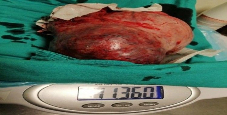 Hamile sanılan kadının karnından 11 kilo ur çıktı