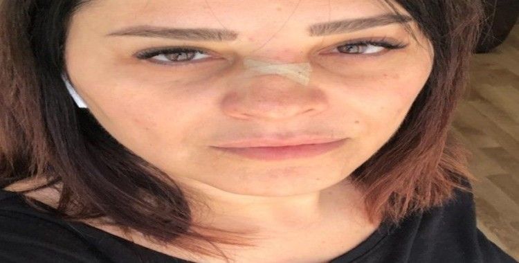 Ünlü şarkıcı Reyhan Karaca'nın burnu kırıldı