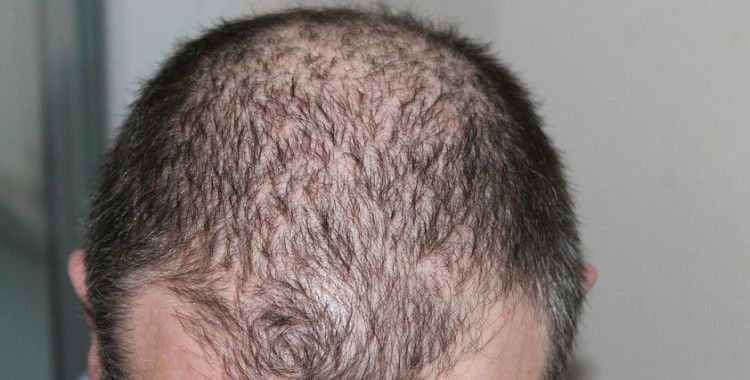 Kovid-19 sonrasında saç dökülmelerinde artış görülüyor