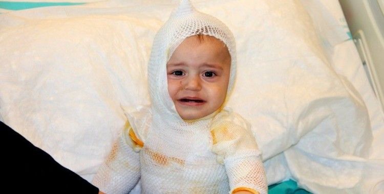 Üzerine kaynar süt dökülen 1 yaşındaki çocuk feci şekilde yandı