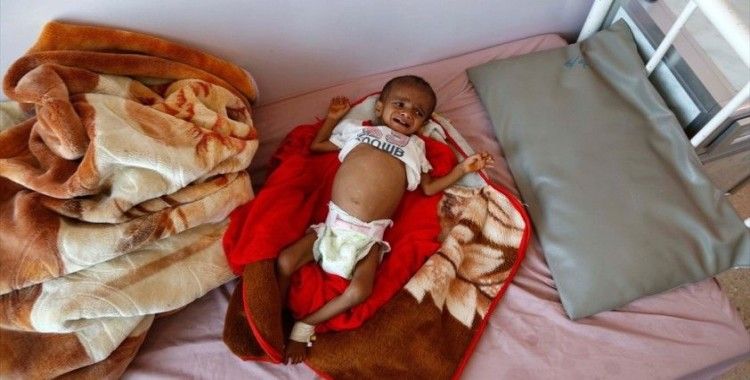 Yemen'de akut yetersiz beslenme sorunu çocukların hayatını karartıyor