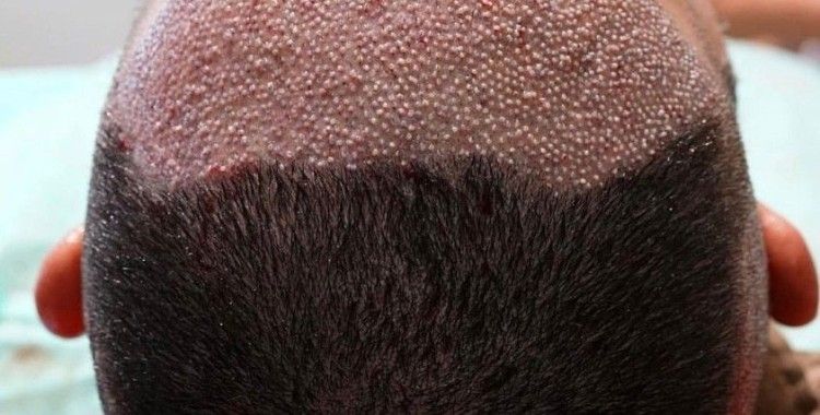 Saç ekiminde fiyatı kök miktarı belirliyor