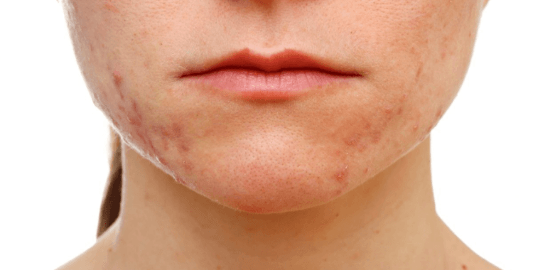 2030 yılında toplumun yüzde 50’si alerjik hasta olabilir