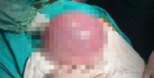 54 yaşındaki hastanın karnında bulunan dev tümör başarıyla çıkarıldı
