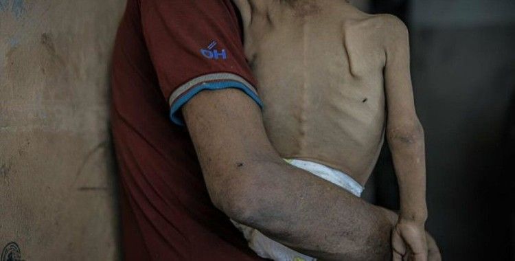 Gazze'de 127 Filistinli açlıktan hayatını kaybetti