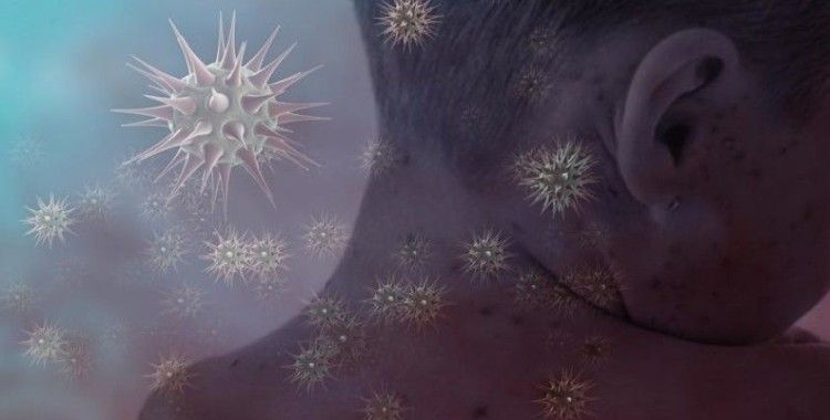 Endonezya'da kızamık salgınında 17 kişi hayatını kaybetti