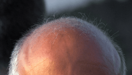 Tıp tarihinde dönüm noktası: Erkek tipi kellik için ilaç bulundu