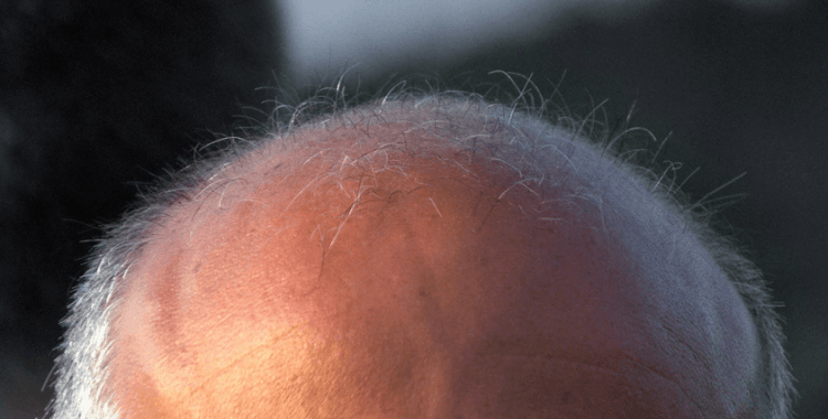 Tıp tarihinde dönüm noktası: Erkek tipi kellik için ilaç bulundu